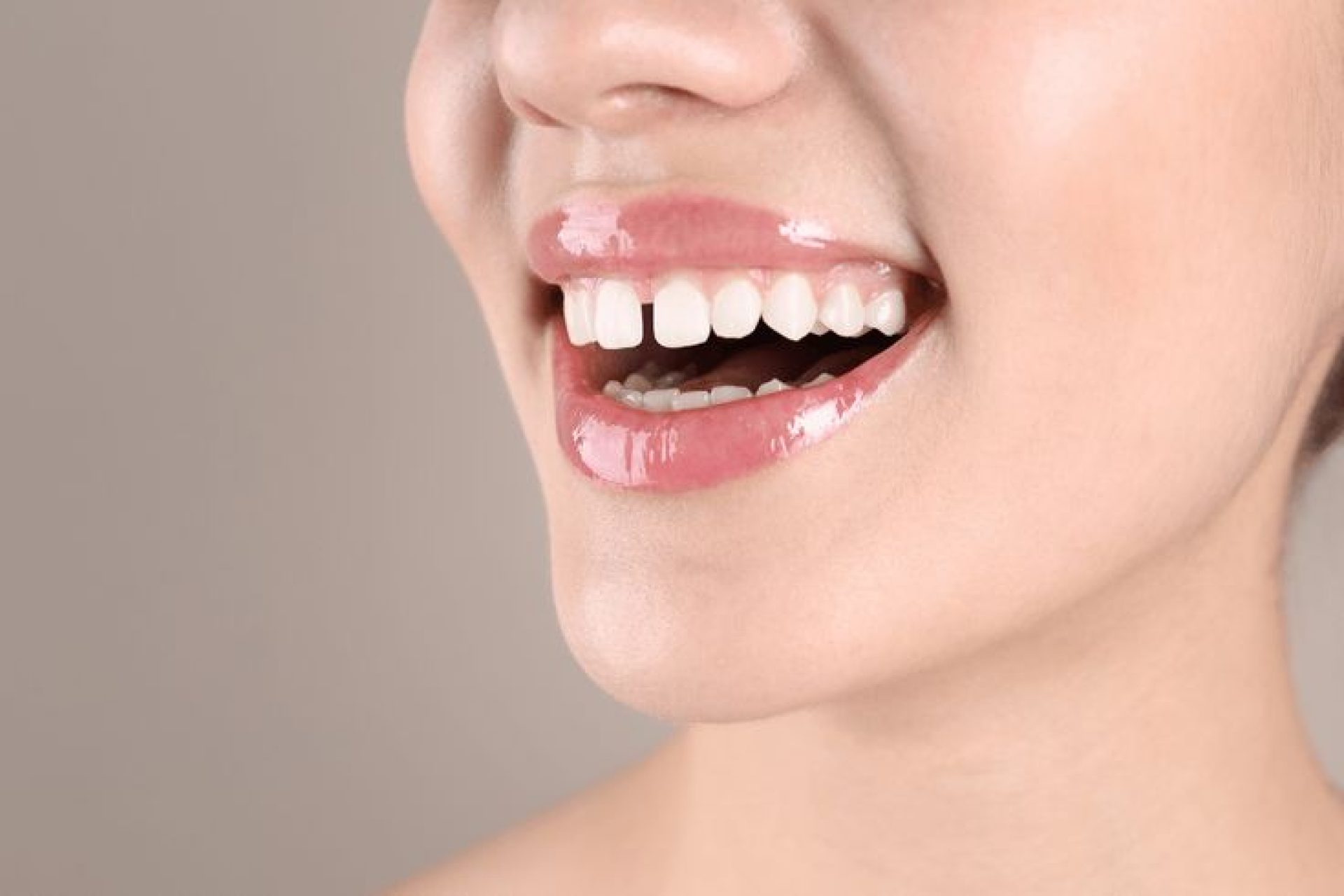 teeth gap treatment